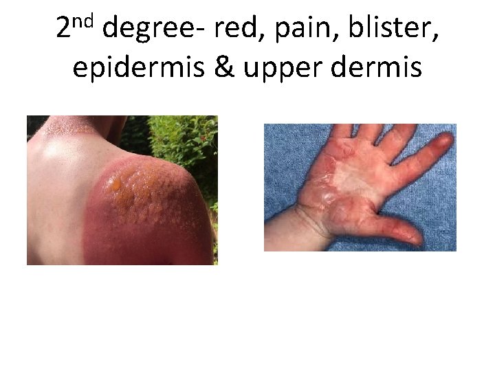 nd 2 degree- red, pain, blister, epidermis & upper dermis 