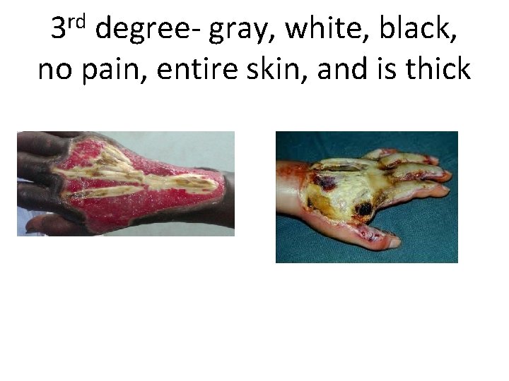 rd 3 degree- gray, white, black, no pain, entire skin, and is thick 