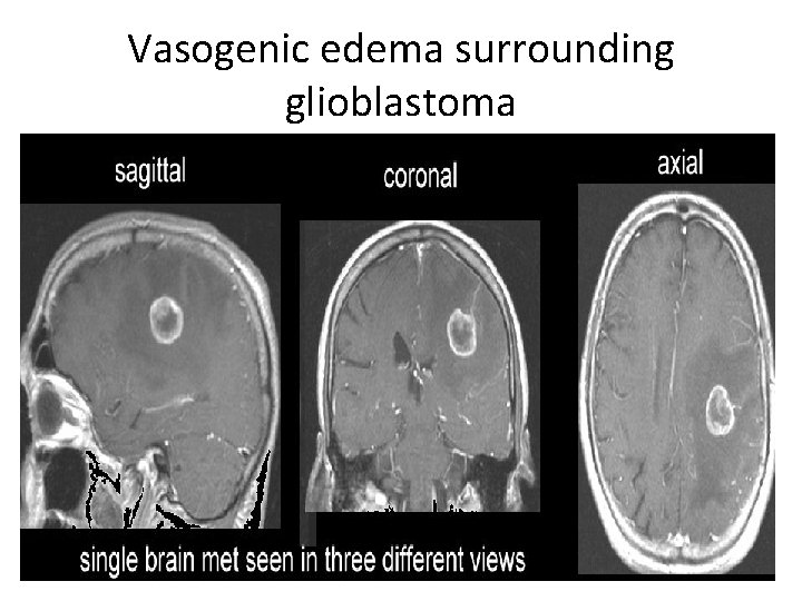 Vasogenic edema surrounding glioblastoma 