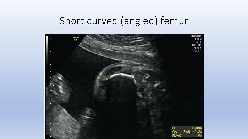 Short curved (angled) femur 