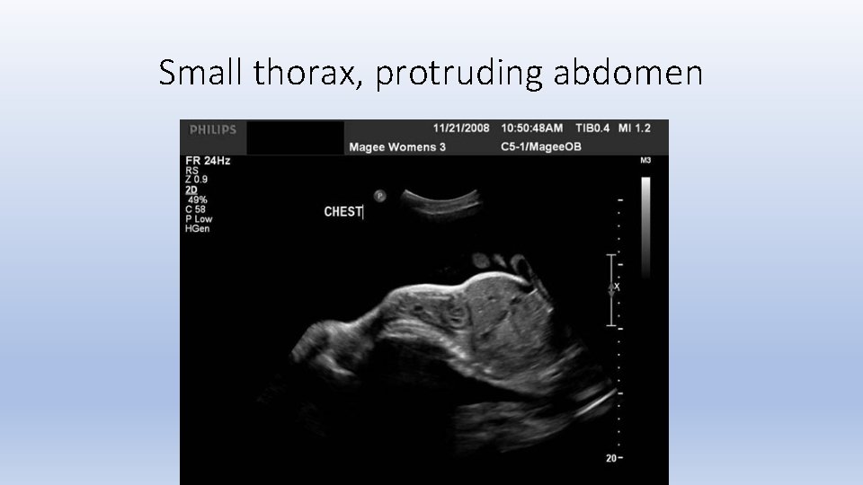 Small thorax, protruding abdomen 