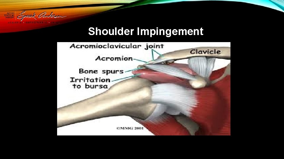 Shoulder Impingement 