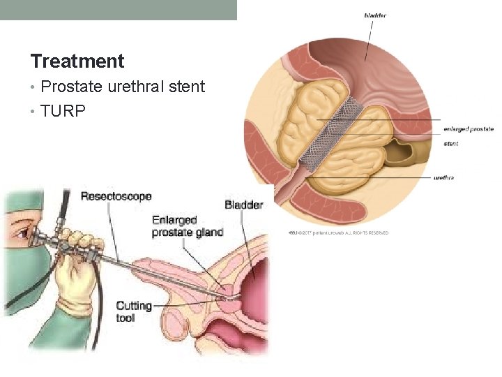 Treatment • Prostate urethral stent • TURP 