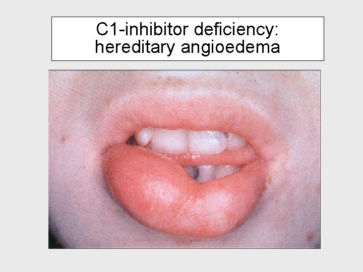 C 1 -inhibitor deficiency: hereditary angioedema 