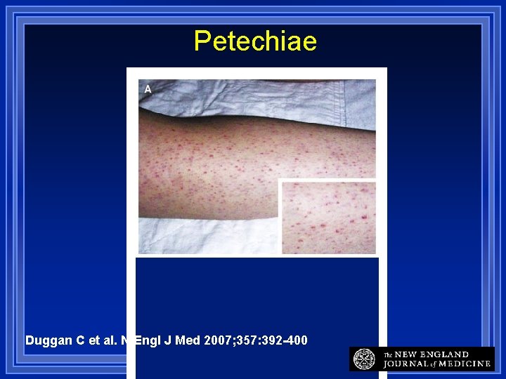 Petechiae Duggan C et al. N Engl J Med 2007; 357: 392 -400 