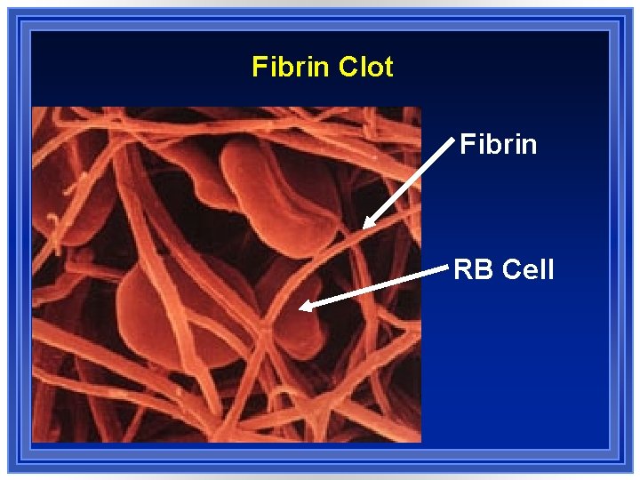 Fibrin Clot Fibrin RB Cell 