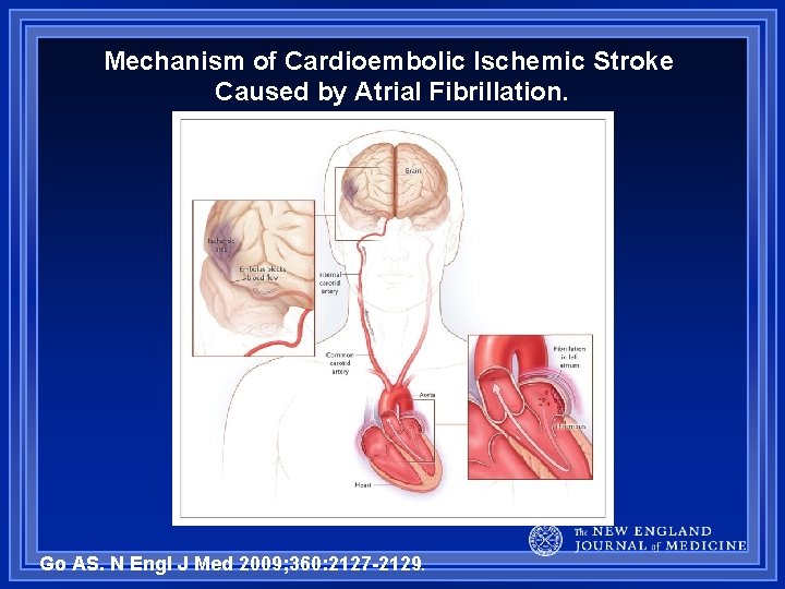 Mechanism of Cardioembolic Ischemic Stroke Caused by Atrial Fibrillation. Go AS. N Engl J