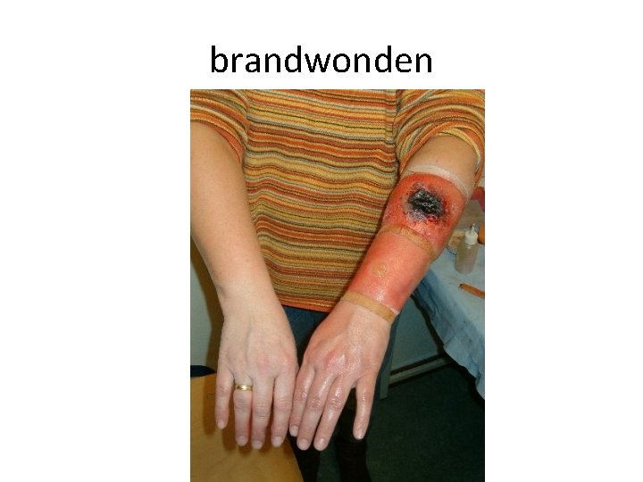 brandwonden 