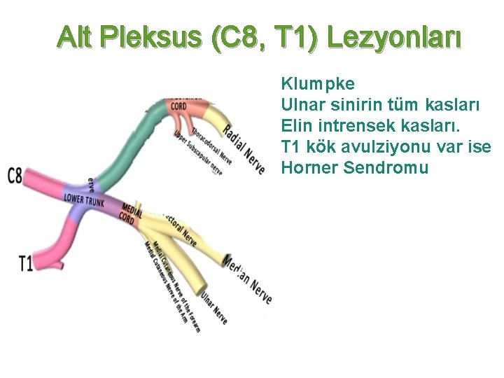 Alt Pleksus (C 8, T 1) Lezyonları Klumpke Ulnar sinirin tüm kasları Elin intrensek