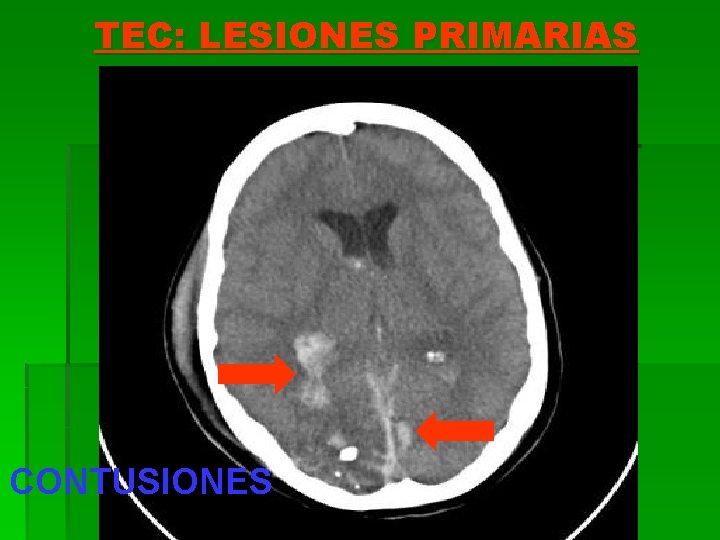 TEC: LESIONES PRIMARIAS CONTUSIONES 