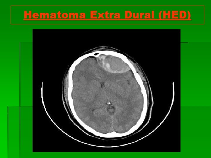 Hematoma Extra Dural (HED) 