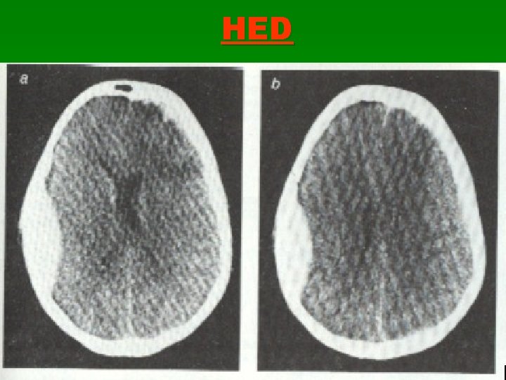 HED 