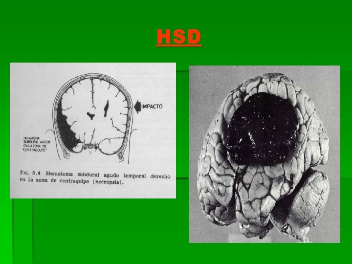 HSD 
