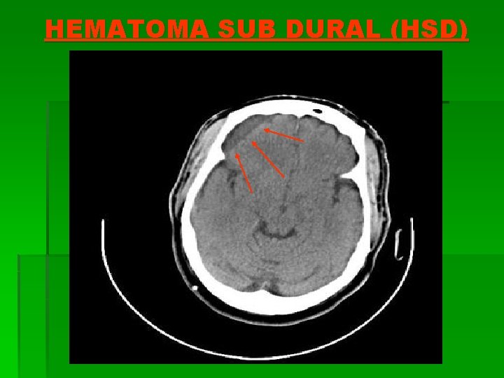 HEMATOMA SUB DURAL (HSD) 