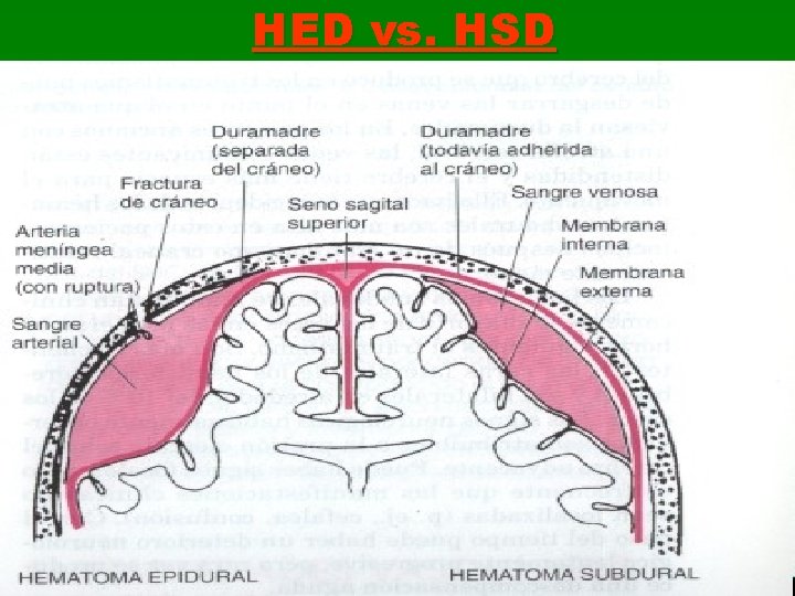 HED vs. HSD 