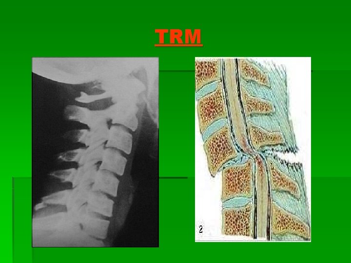 TRM 