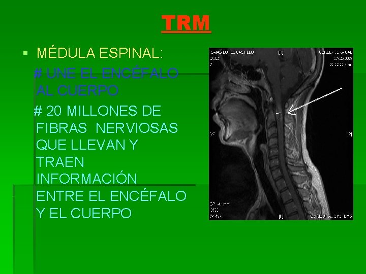 TRM § MÉDULA ESPINAL: # UNE EL ENCÉFALO AL CUERPO # 20 MILLONES DE