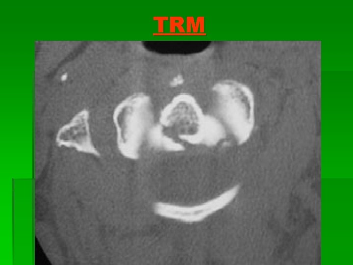 TRM 