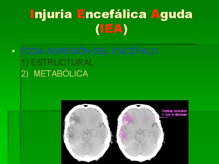 Injuria Encefálica Aguda (IEA) § TODA AGRESIÓN DEL ENCÉFALO 1) ESTRUCTURAL 2) METABÓLICA 