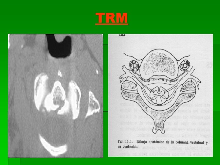 TRM 