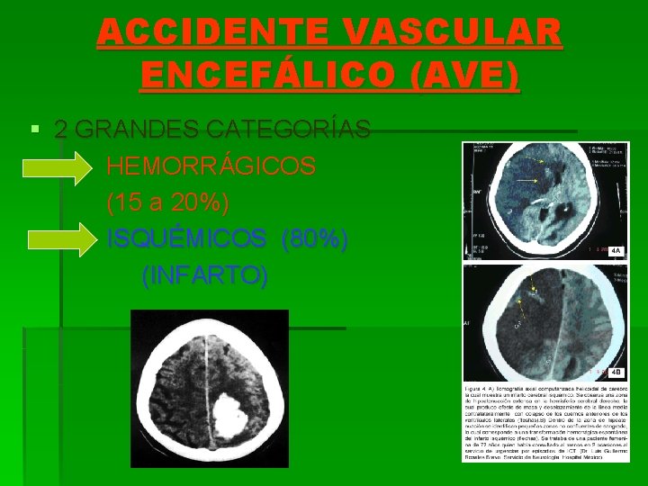 ACCIDENTE VASCULAR ENCEFÁLICO (AVE) § 2 GRANDES CATEGORÍAS HEMORRÁGICOS (15 a 20%) ISQUÉMICOS (80%)
