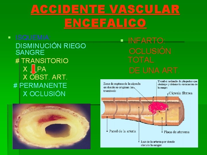 ACCIDENTE VASCULAR ENCEFALICO § ISQUEMIA: DISMINUCIÓN RIEGO SANGRE # TRANSITORIO X PA X OBST.