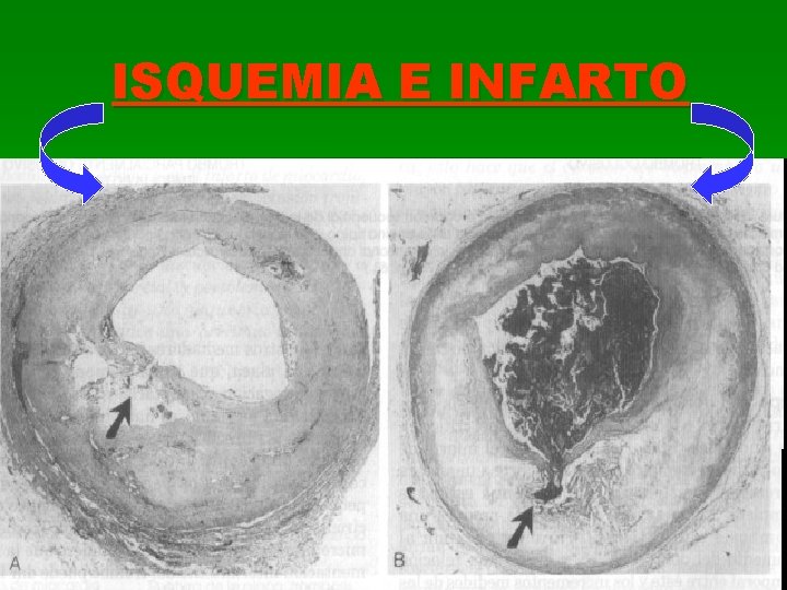 ISQUEMIA E INFARTO 
