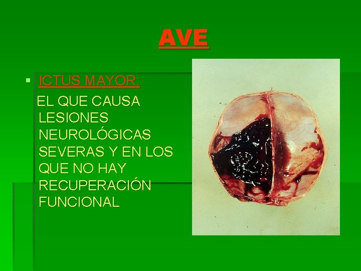 AVE § ICTUS MAYOR: EL QUE CAUSA LESIONES NEUROLÓGICAS SEVERAS Y EN LOS QUE