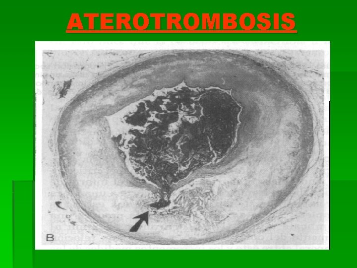 ATEROTROMBOSIS 