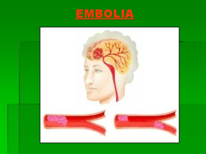 EMBOLIA 