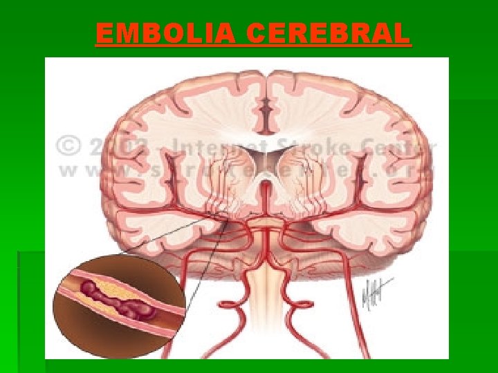 EMBOLIA CEREBRAL 