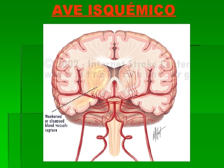 AVE ISQUÉMICO 