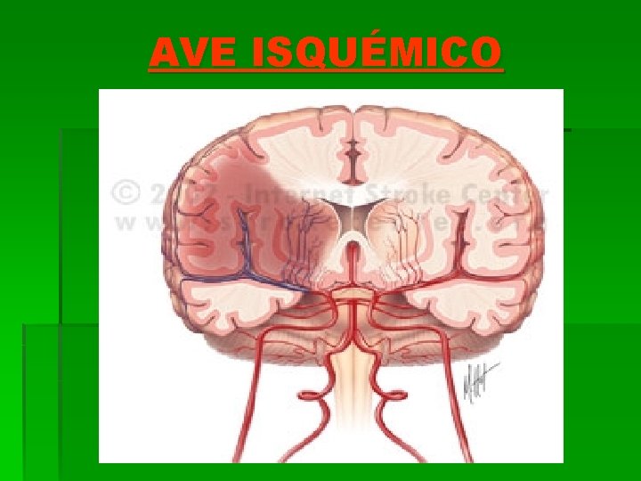 AVE ISQUÉMICO 