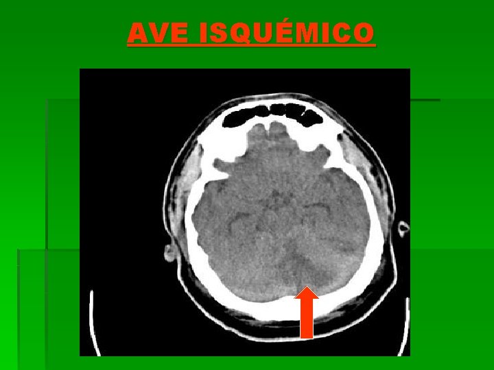 AVE ISQUÉMICO 