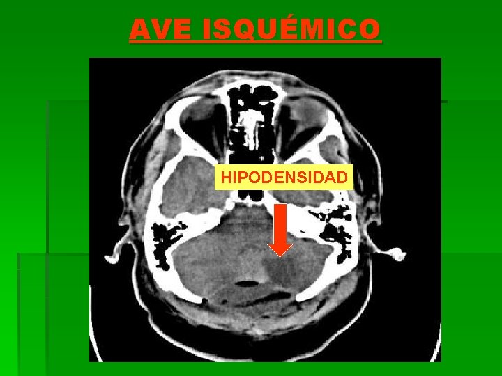 AVE ISQUÉMICO HIPODENSIDAD 