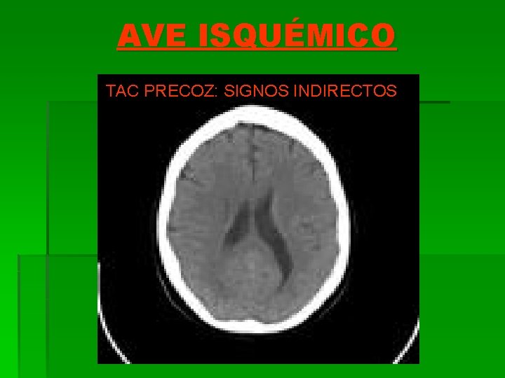 AVE ISQUÉMICO TAC PRECOZ: SIGNOS INDIRECTOS 