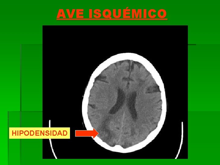 AVE ISQUÉMICO HIPODENSIDAD 