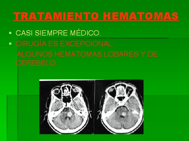 TRATAMIENTO HEMATOMAS § CASI SIEMPRE MÉDICO. § CIRUGÍA ES EXCEPCIONAL: ALGUNOS HEMATOMAS LOBARES Y