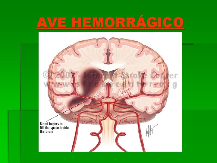 AVE HEMORRÁGICO 