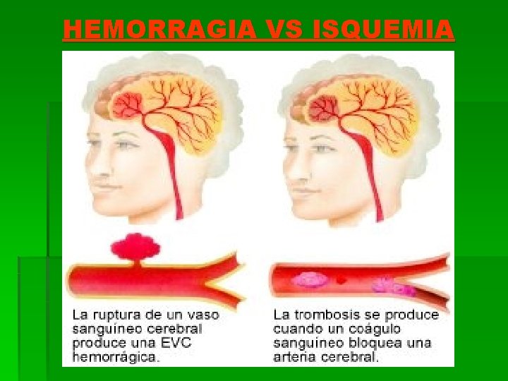 HEMORRAGIA VS ISQUEMIA 