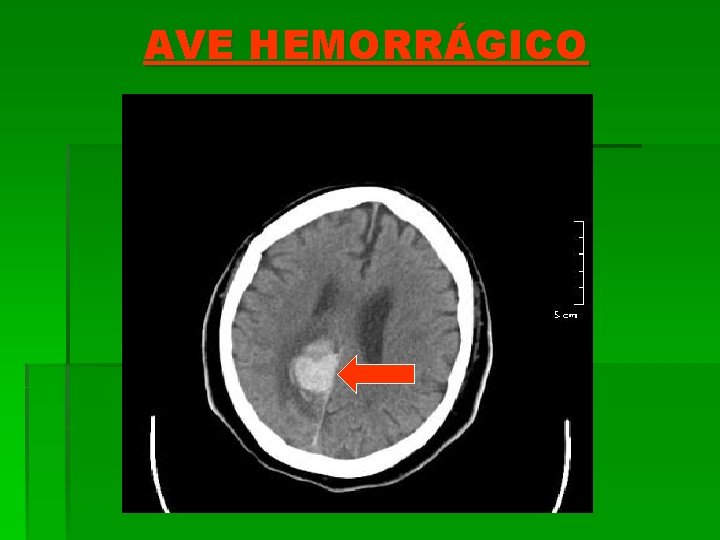 AVE HEMORRÁGICO 