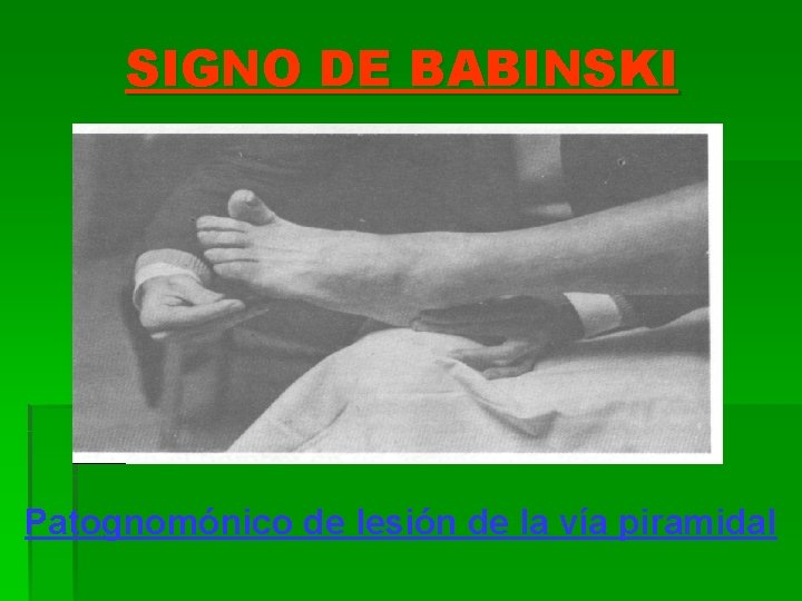 SIGNO DE BABINSKI Patognomónico de lesión de la vía piramidal 
