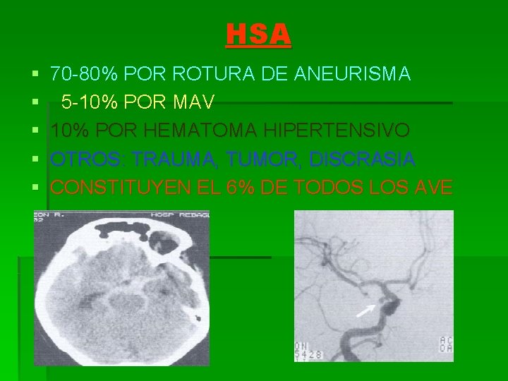 HSA § § § 70 -80% POR ROTURA DE ANEURISMA 5 -10% POR MAV