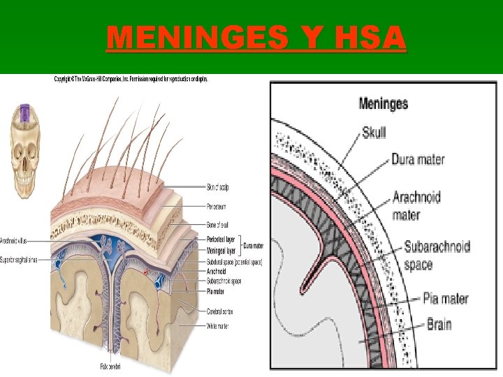 MENINGES Y HSA 