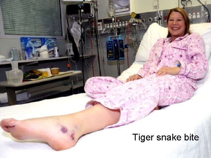 Tiger snake bite 