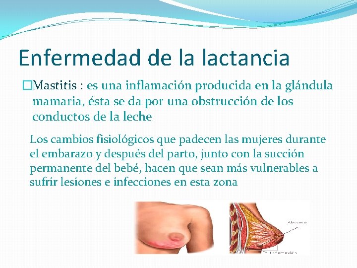 Enfermedad de la lactancia �Mastitis : es una inflamación producida en la glándula mamaria,