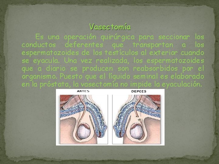 Vasectomía Es una operación quirúrgica para seccionar los conductos deferentes que transportan a los