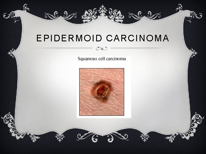EPIDERMOID CARCINOMA 