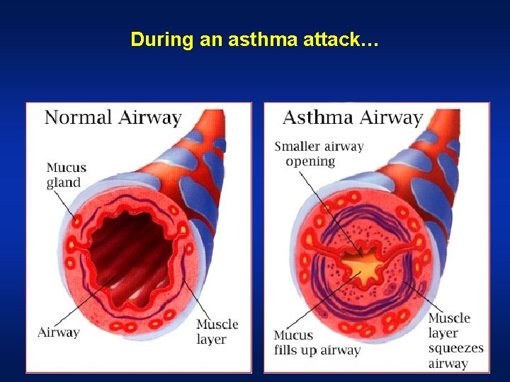 During an asthma attack…  During an asthma attack…