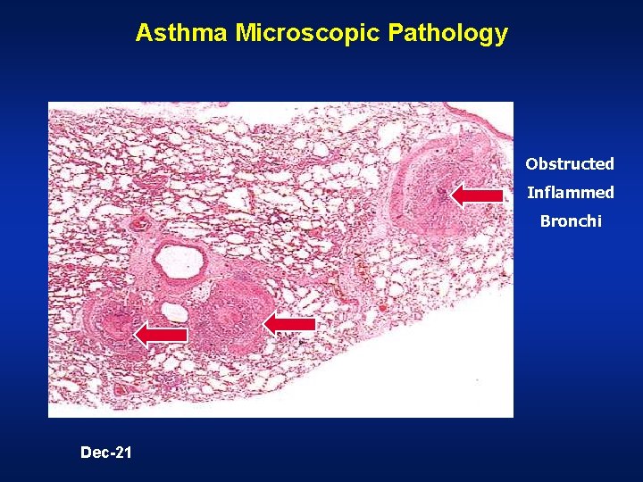 Asthma Microscopic Pathology Obstructed Inflammed Bronchi Dec-21 